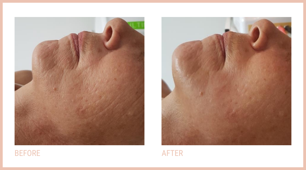 https://foxandrae.co.uk/wp-content/uploads/2023/03/The-Verwood-CACI-Clinic-Non-Surgical-Facelift-1024x569.png